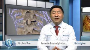 Posterior Lumbar Fusion